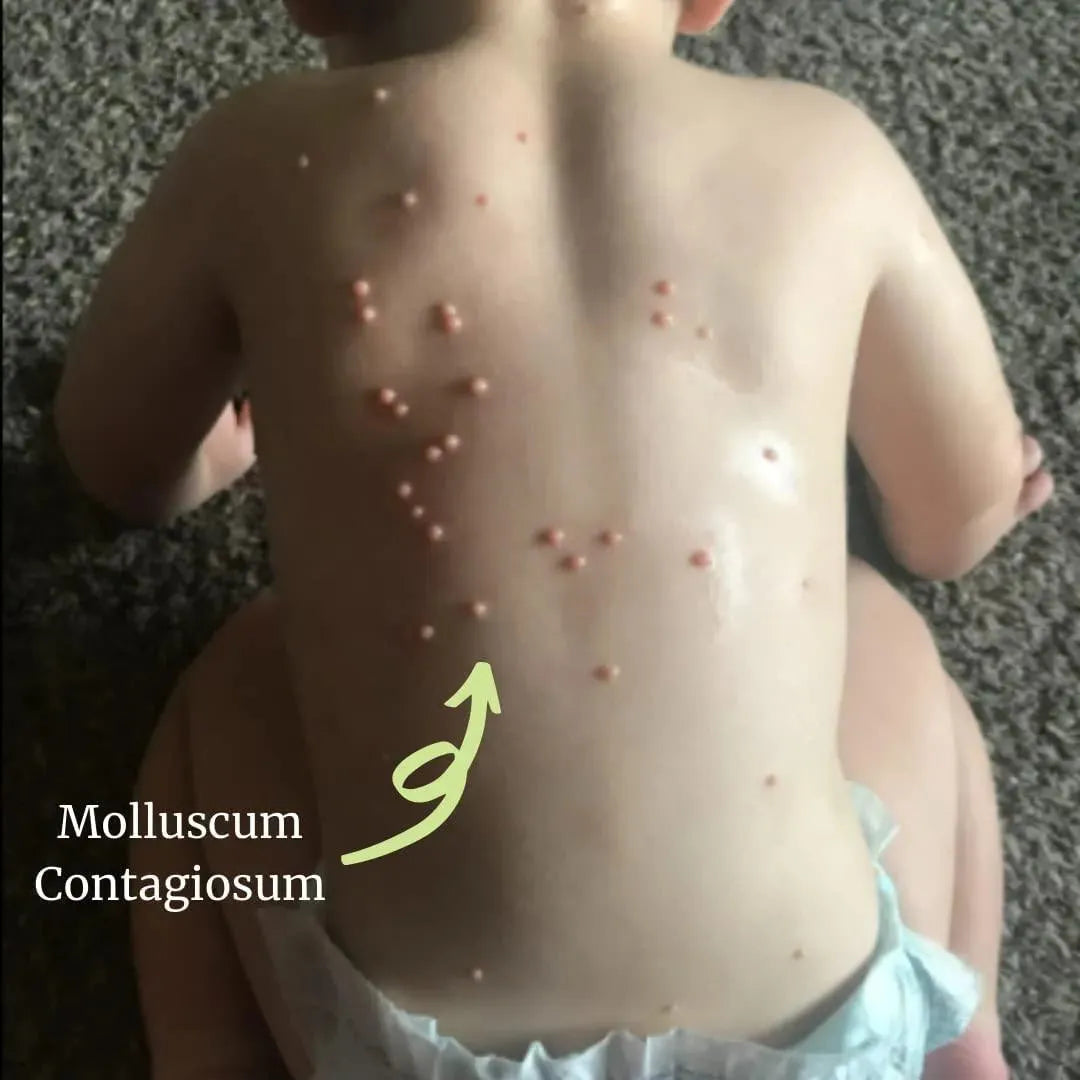 NATURASII - Naturasil Molluscum All Natural Homeopathic 15Ml. - The Red Vitamin MX - Tratamiento Molusco Contagioso - {{ shop.shopifyCountryName }}