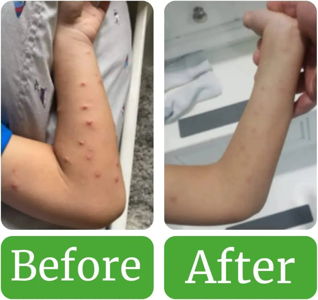 NATURASIL - Naturasil for Molluscum Treatment Kit All Natural 15Ml. & 4Oz. Liquido y Jabón - The Red Vitamin MX - Tratamiento Molusco Contagioso - {{ shop.shopifyCountryName }}