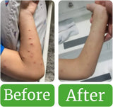 NATURASIL - Naturasil for Molluscum Treatment Kit All Natural 15Ml. & 4Oz. Liquido y Jabón - The Red Vitamin MX - Tratamiento Molusco Contagioso - {{ shop.shopifyCountryName }}