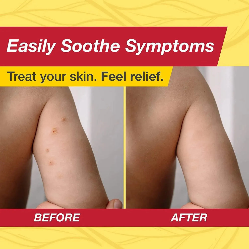 ZYMADERM - ZymaDerm Natural Molluscum Contagiosum Treatment 13Ml. - The Red Vitamin MX - Tratamiento Molusco Contagioso - {{ shop.shopifyCountryName }}